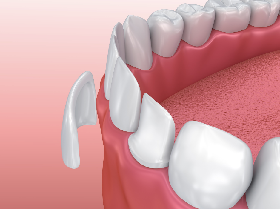 graphic of dental veneers in coral gables fl